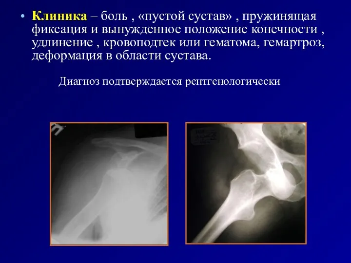 Клиника – боль , «пустой сустав» , пружинящая фиксация и