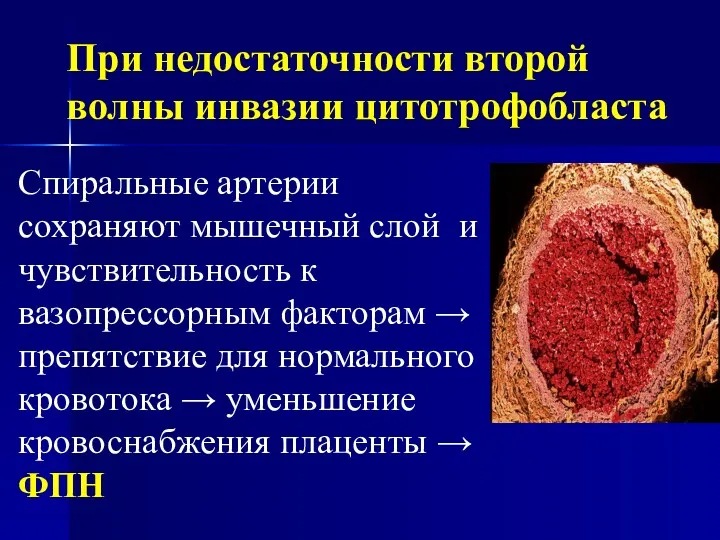 При недостаточности второй волны инвазии цитотрофобласта Спиральные артерии сохраняют мышечный