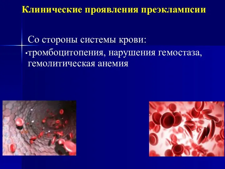 Клинические проявления преэклампсии Со стороны системы крови: тромбоцитопения, нарушения гемостаза, гемолитическая анемия