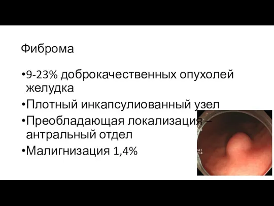 Фиброма 9-23% доброкачественных опухолей желудка Плотный инкапсулиованный узел Преобладающая локализация – антральный отдел Малигнизация 1,4%