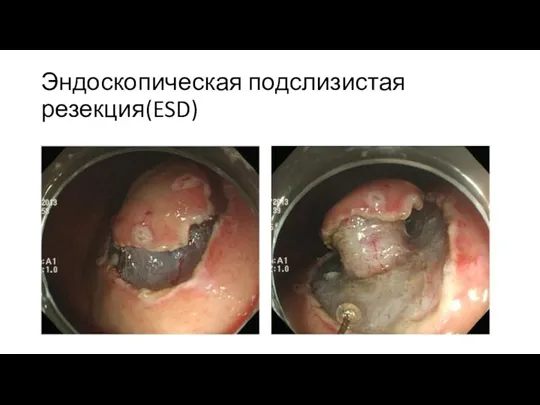 Эндоскопическая подслизистая резекция(ESD)