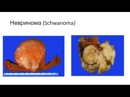 Невринома (Schwanoma)
