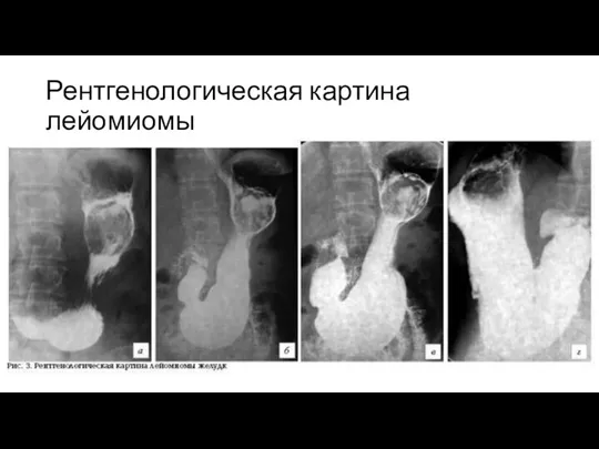 Рентгенологическая картина лейомиомы