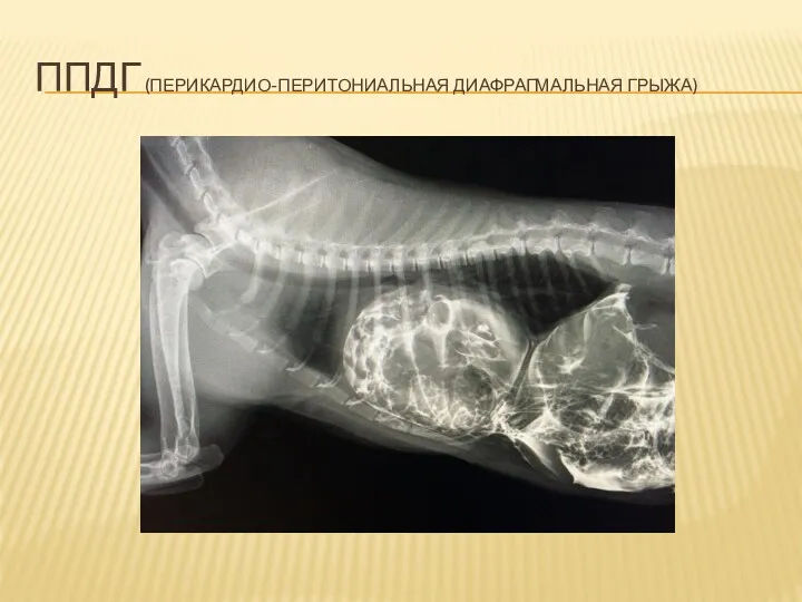 ППДГ (ПЕРИКАРДИО-ПЕРИТОНИАЛЬНАЯ ДИАФРАГМАЛЬНАЯ ГРЫЖА)
