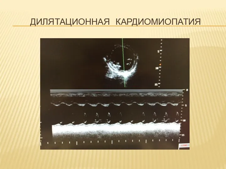 ДИЛЯТАЦИОННАЯ КАРДИОМИОПАТИЯ