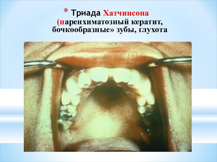 Триада Хатчинсона (паренхиматозный кератит, бочкообразные» зубы, глухота
