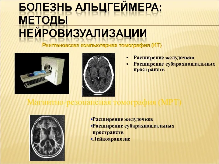 Рентгеновская компьютерная томография (КТ) Расширение желудочков Расширение субарахноидальных пространств Магнитно-резонансная