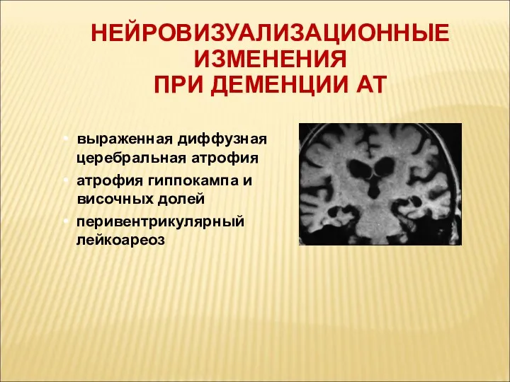 НЕЙРОВИЗУАЛИЗАЦИОННЫЕ ИЗМЕНЕНИЯ ПРИ ДЕМЕНЦИИ АТ выраженная диффузная церебральная атрофия атрофия гиппокампа и височных долей перивентрикулярный лейкоареоз