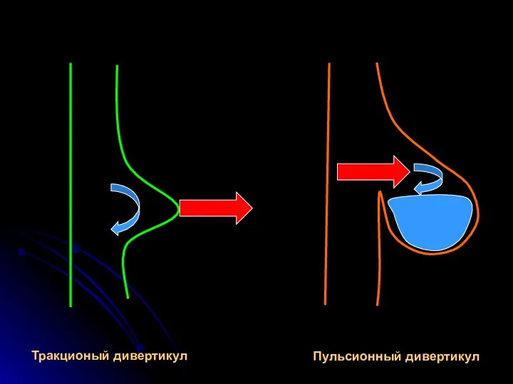 Тракционый дивертикул Пульсионный дивертикул