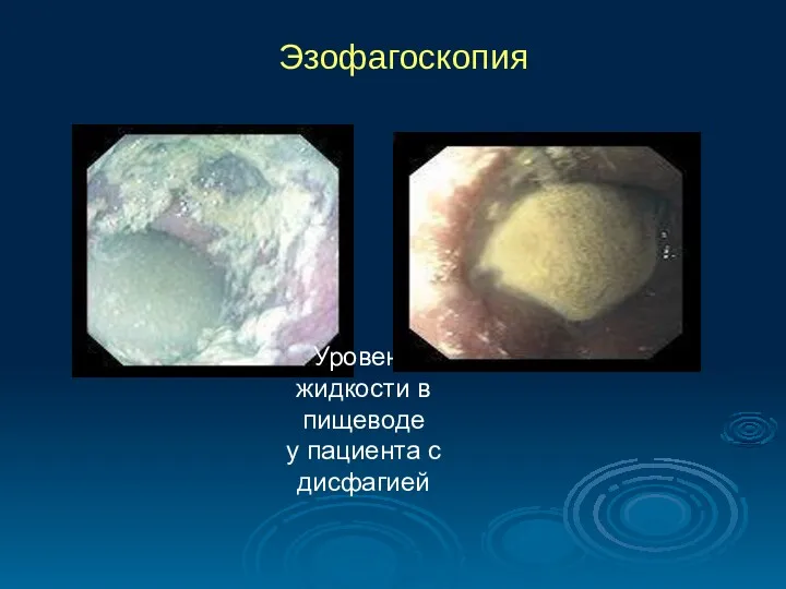 Эзофагоскопия Уровень жидкости в пищеводе у пациента с дисфагией