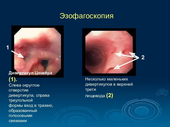 Эзофагоскопия Дивертикул Ценкера (1). Слева округлое отверстие дивертикула, справа треугольной