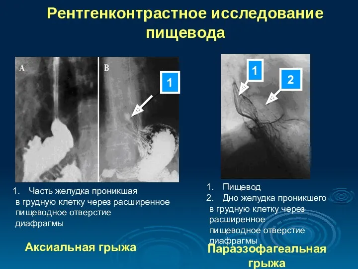 Рентгенконтрастное исследование пищевода Часть желудка проникшая в грудную клетку через