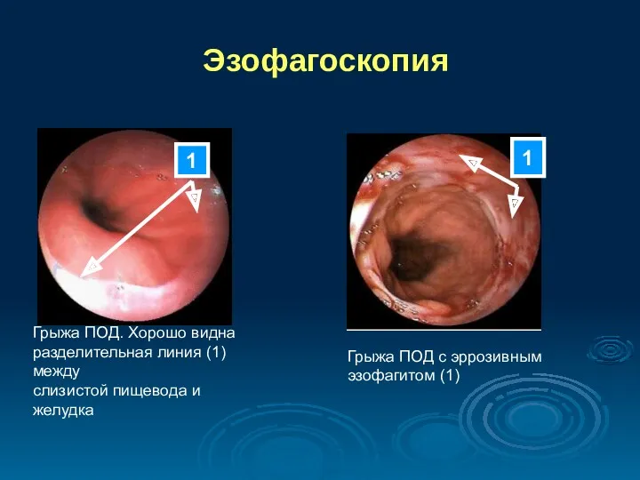 Эзофагоскопия Грыжа ПОД. Хорошо видна разделительная линия (1) между слизистой