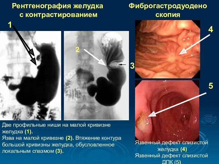 Рентгенография желудка с контрастированием Фиброгастродуоденоскопия Язвенный дефект слизистой желудка (4)
