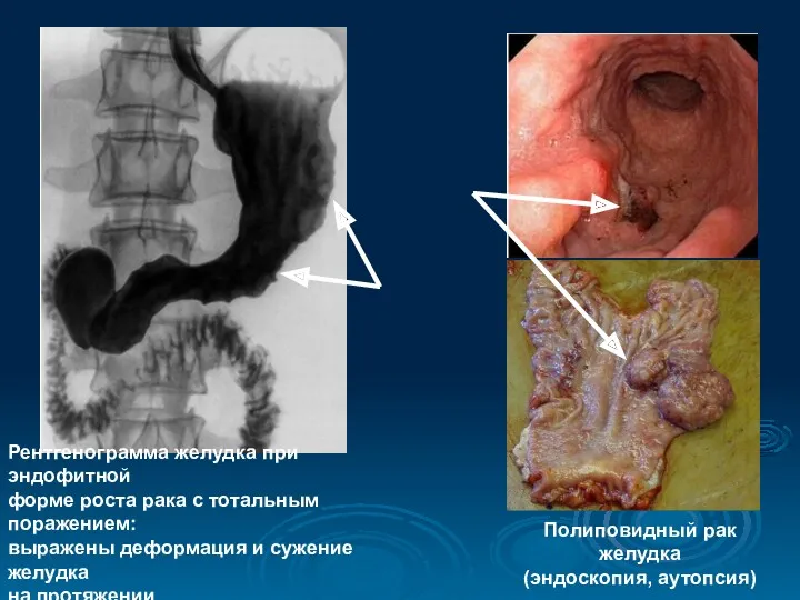 Рентгенограмма желудка при эндофитной форме роста рака с тотальным поражением: