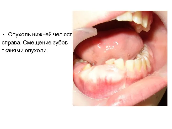 Опухоль нижней челюсти справа. Смещение зубов тканями опухоли.