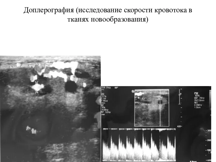 Доплерография (исследование скорости кровотока в тканях новообразования)