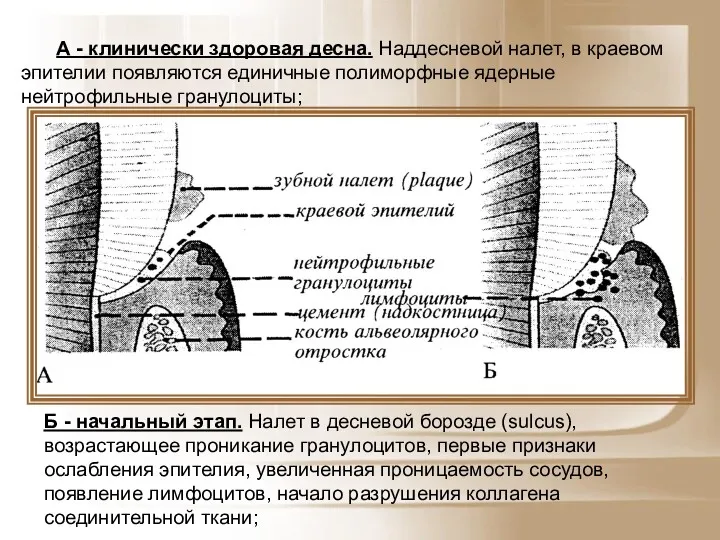 А - клинически здоровая десна. Наддесневой налет, в краевом эпителии