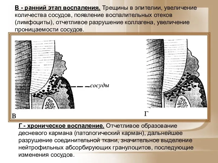 В - ранний этап воспаления. Трещины в эпителии, увеличение количества