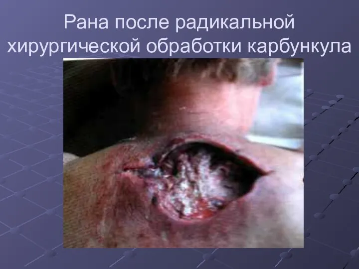 Рана после радикальной хирургической обработки карбункула
