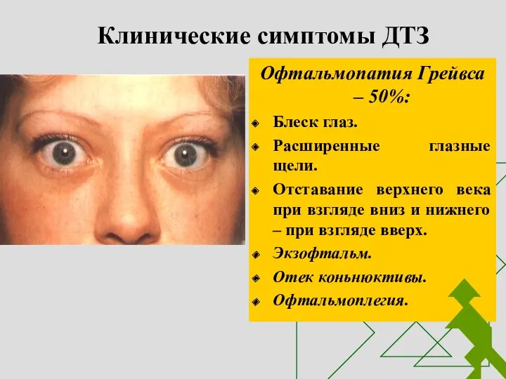 Клинические симптомы ДТЗ Офтальмопатия Грейвса – 50%: Блеск глаз. Расширенные