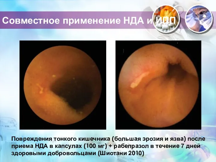 Повреждения тонкого кишечника (большая эрозия и язва) после приема НДА