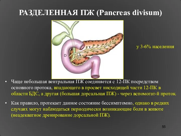 РАЗДЕЛЕННАЯ ПЖ (Pancreas divisum) Чаще небольшая вентральная ПЖ соединяется с 12-ПК посредством основного