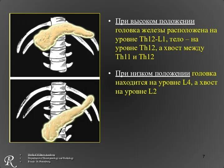При высоком положении головка железы расположена на уровне Th12-L1, тело – на уровне