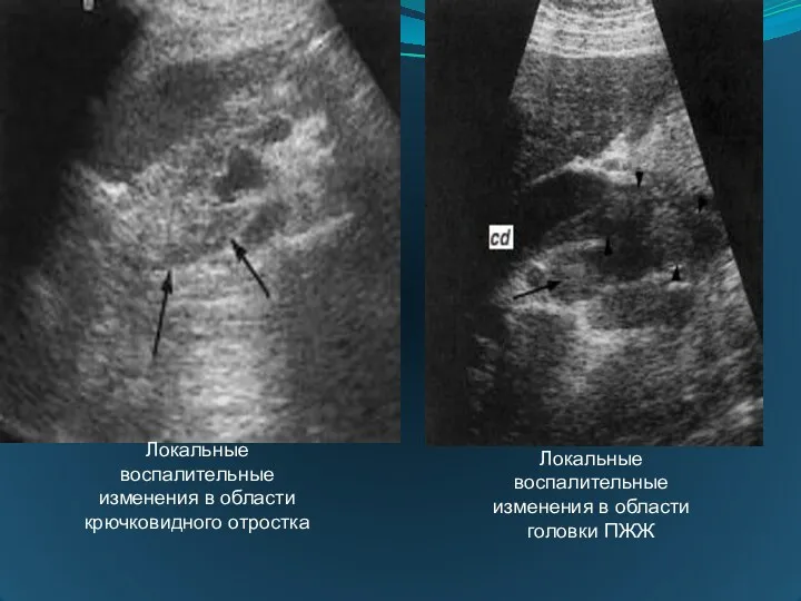 Локальные воспалительные изменения в области крючковидного отростка Локальные воспалительные изменения в области головки ПЖЖ