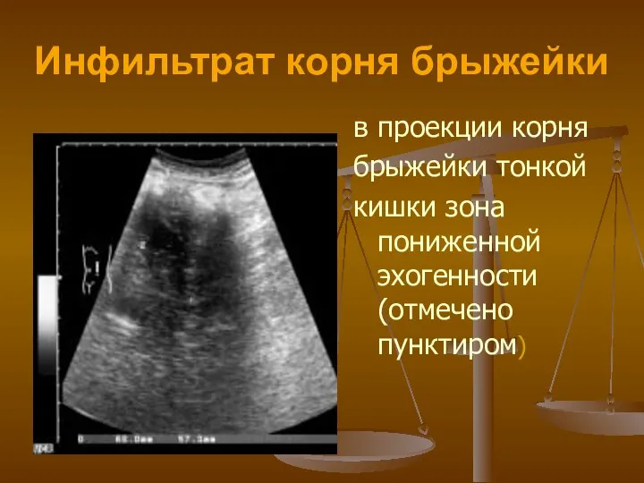 Инфильтрат корня брыжейки в проекции корня брыжейки тонкой кишки зона пониженной эхогенности (отмечено пунктиром)