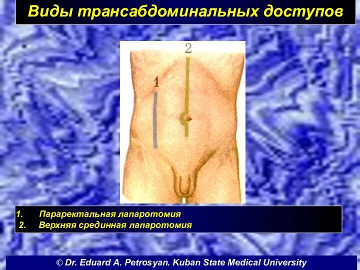 Виды трансабдоминальных доступов Параректальная лапаротомия 2. Верхняя срединная лапаротомия ©