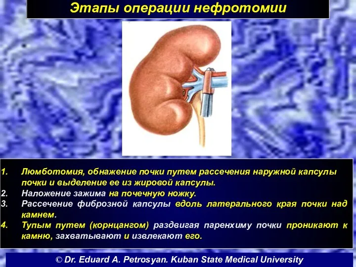 Этапы операции нефротомии Люмботомия, обнажение почки путем рассечения наружной капсулы