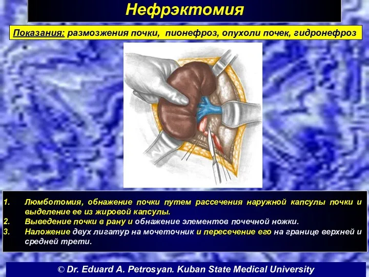 Нефрэктомия Люмботомия, обнажение почки путем рассечения наружной капсулы почки и