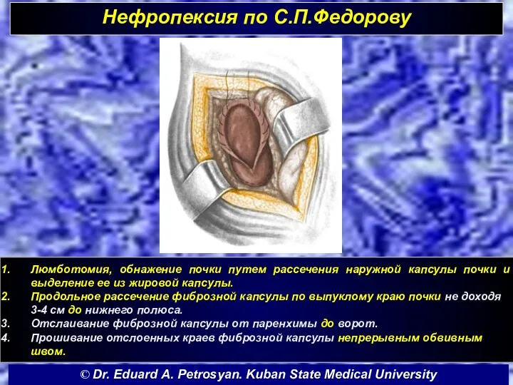 Нефропексия по С.П.Федорову Люмботомия, обнажение почки путем рассечения наружной капсулы