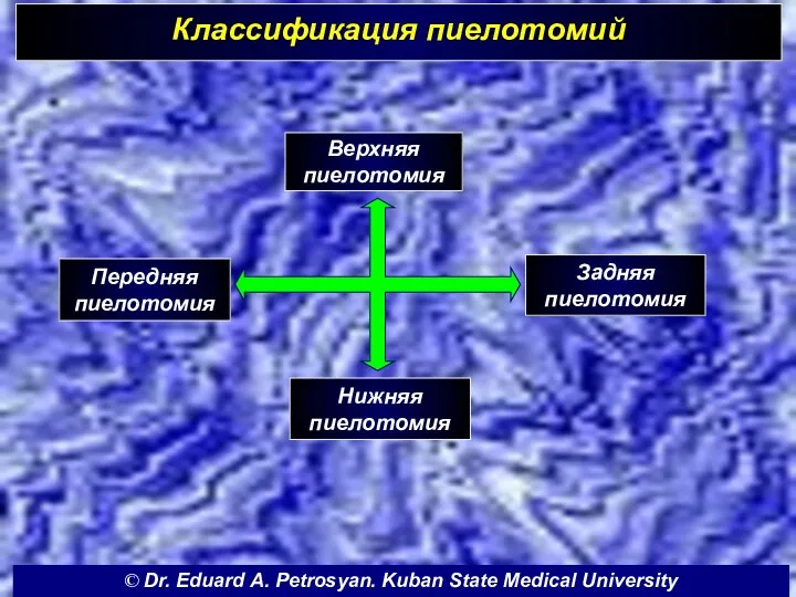 Классификация пиелотомий Верхняя пиелотомия Задняя пиелотомия Нижняя пиелотомия Передняя пиелотомия