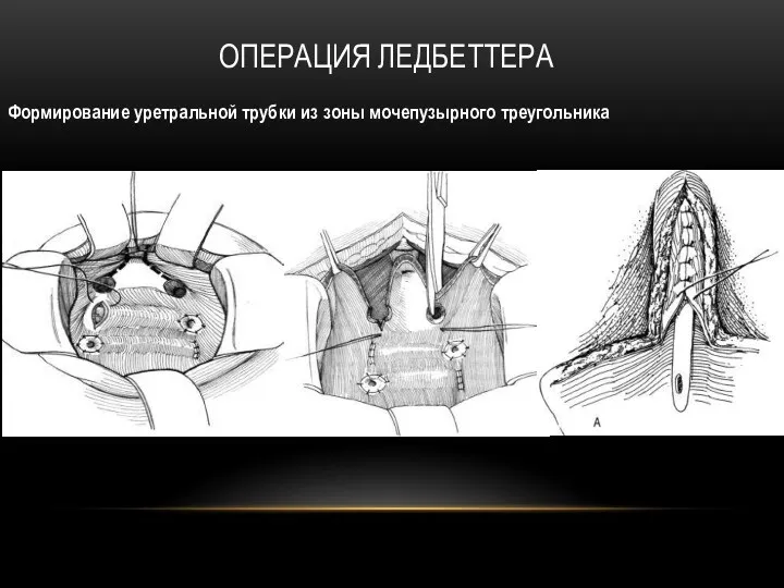 ОПЕРАЦИЯ ЛЕДБЕТТЕРА Формирование уретральной трубки из зоны мочепузырного треугольника