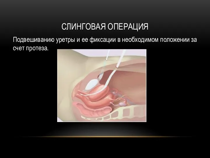 СЛИНГОВАЯ ОПЕРАЦИЯ Подвешиванию уретры и ее фиксации в необходимом положении за счет протеза.