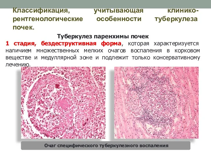 Классификация, учитывающая клинико-рентгенологические особенности туберкулеза почек. Туберкулез паренхимы почек 1