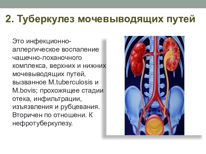 2. Туберкулез мочевыводящих путей Это инфекционно-аллергическое воспаление чашечно-лоханочного комплекса, верхних