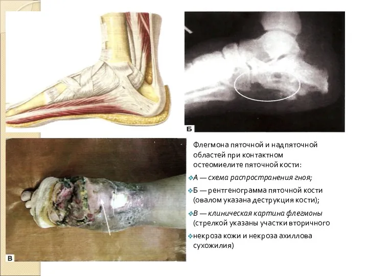 Флегмона пяточной и надпяточной областей при контактном остеомиелите пяточной кости: А — схема