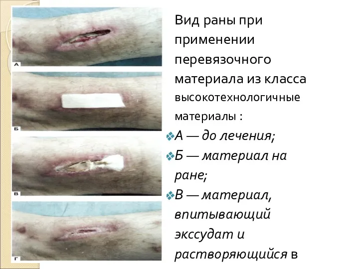 Вид раны при применении перевязочного материала из класса высокотехнологичные материалы : А —