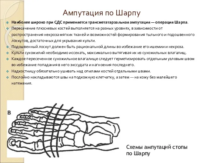 Ампутация по Шарпу Наиболее широко при СДС применяется трансметатарзальная ампутация — операция Шарпа.