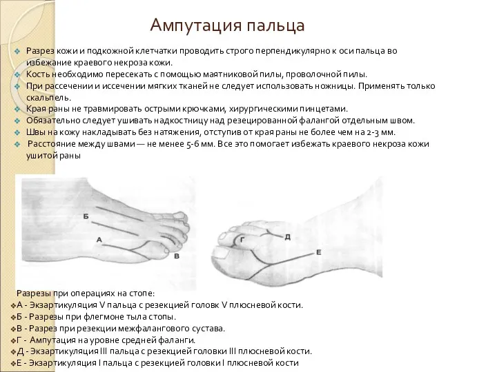 Ампутация пальца Разрез кожи и подкожной клетчатки проводить строго перпендикулярно к оси пальца