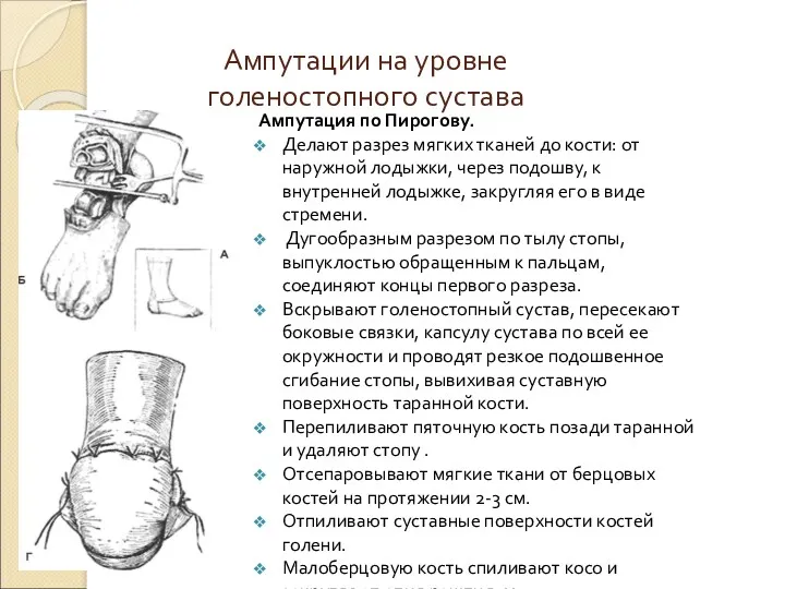 Ампутации на уровне голеностопного сустава Ампутация по Пирогову. Делают разрез мягких тканей до