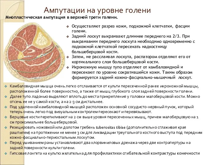 Ампутации на уровне голени Камбаловидная мышца очень легко отслаивается от культи пересеченной ранее