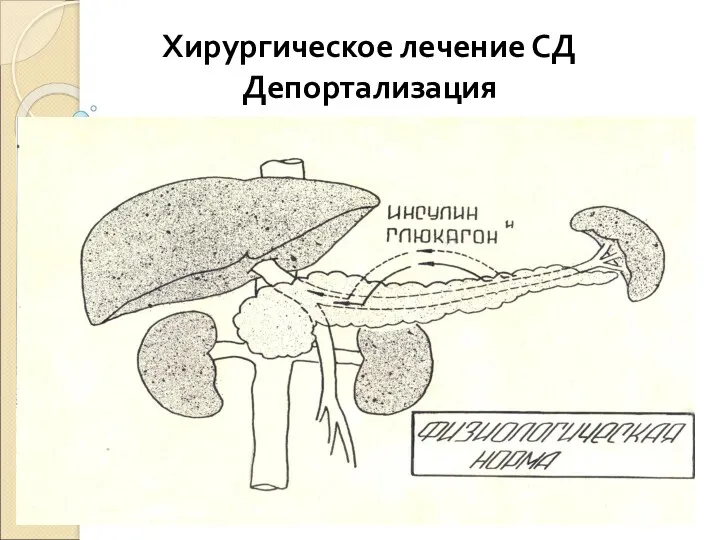 Хирургическое лечение СД Депортализация