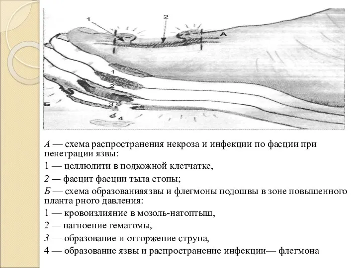 А — схема распространения некроза и инфекции по фасции при пенетрации язвы: 1