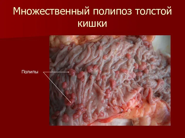 Множественный полипоз толстой кишки Полипы