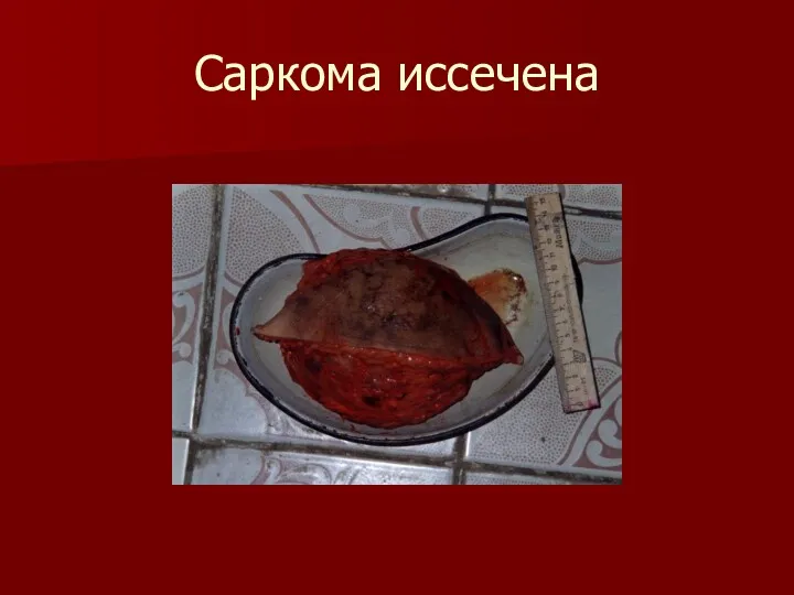 Саркома иссечена