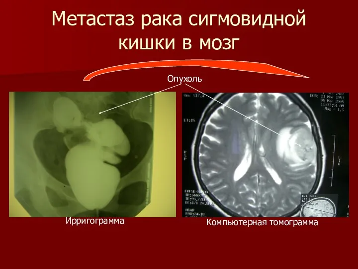 Метастаз рака сигмовидной кишки в мозг Ирригограмма Компьютерная томограмма Опухоль